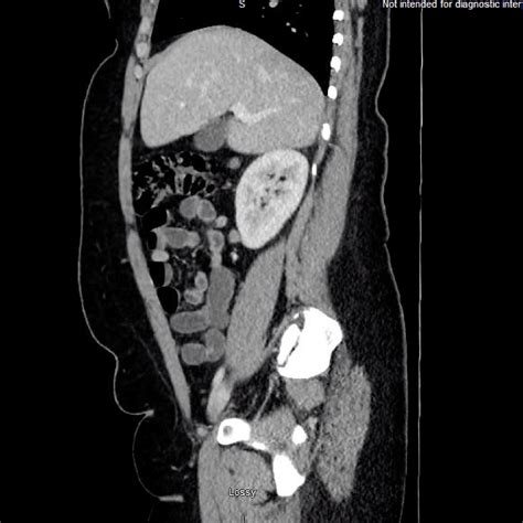 Image result for Small Intestine Jejunum