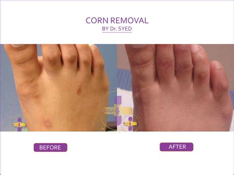 Corn removal in Gurgaon & South Delhi, Saket - Royal Lush