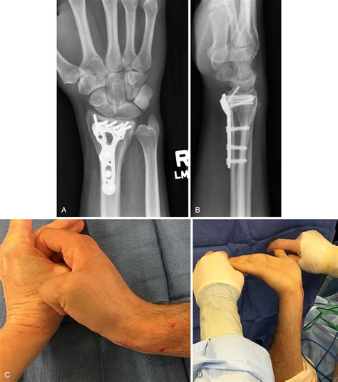 Compartment Syndrome and Volkmann’s Ischemic Contracture - Clinical Tree
