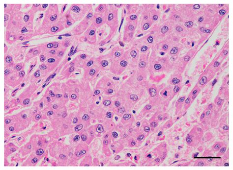 Sorafenib for the Treatment of Unresectable Hepatocellular Carcinoma ...