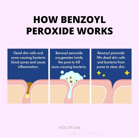 Unlocking the power of benzoyl peroxide aesthetic insights for clearer skin – Artofit