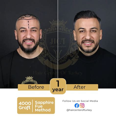 The Science Behind Hair Transplantation | Hair Transplant in Turkey ...