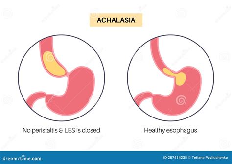 Esophageal Achalasia Disease Stock Vector - Illustration of regurgitation, medical: 287414235