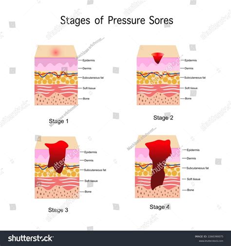 Stages Of Infectious Disease Diagram