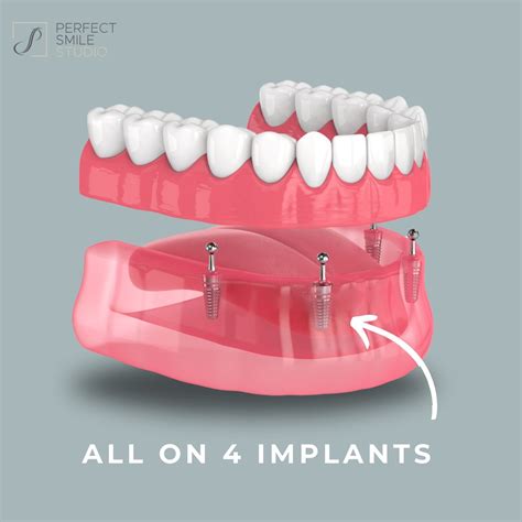 What Is The Cost Of An Implant