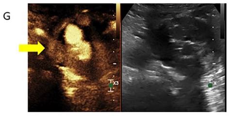 Radiation Dose Reduction Opportunities in Vascular Imaging