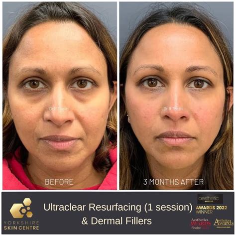 How To Get Rid Of Freckles? Expert & At-Home Solutions - YSC