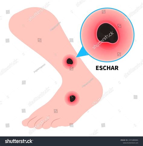 2+ Hundred Eschar Royalty-Free Images, Stock Photos & Pictures ...