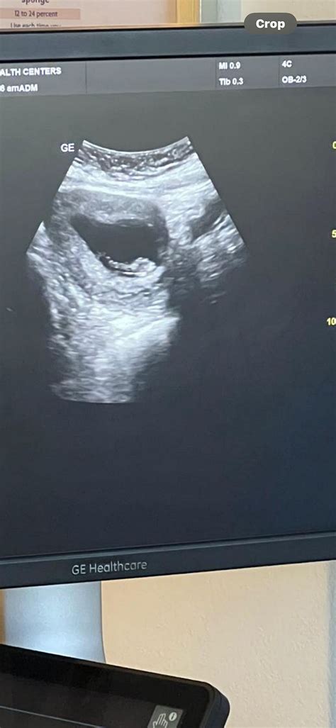 9 week ultrasound | BabyCenter