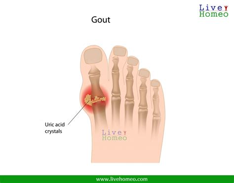 Homeopathy Treatment for Gout Arthritis | Live Homeo