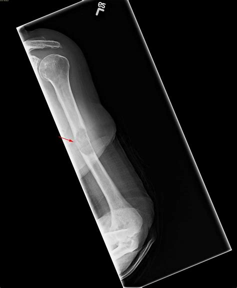 Metastatic thyroid cancer - X Rays Radiology Case Studies - CTisus CT Scanning
