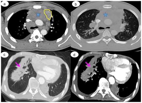 What Is Lung Involvement In Ct Scan at Nicole Webber blog