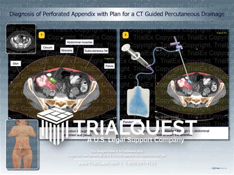 Image result for Perforated Appendix