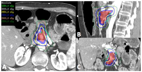 Stereotactic Radiotherapy and Particle Therapy for Pancreatic Cancer