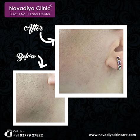 Hirsutism Laser Hair Treatment in Surat, Gujarat, India