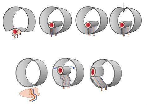What Is Intraperitoneal And Retroperitoneal