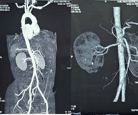 #08 Young Hypertensives , Rising numbers in India : a non communicable ...