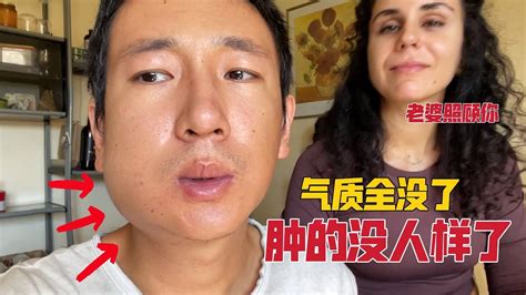 中国老公意外脸破相，意大利媳妇不忍直视，心疼的冲上前抱住老公 - YouTube