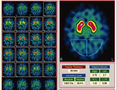 Image result for Normal DaTscan
