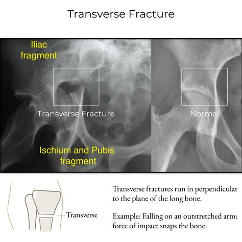Impacted Fracture X Ray