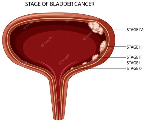 Image result for Bladder Explode