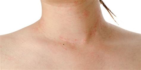 How long does Dengue Rash Last? | OnlyMyHealth