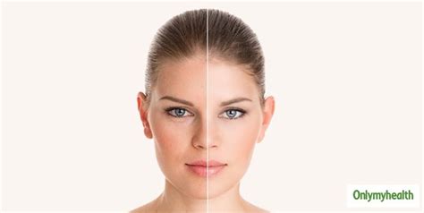 Unleash The Hidden Benefits of Cinnamon For Skin | OnlyMyHealth