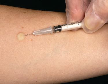 Intradermal Injection (Test for Drug Sensitivity) ~ Nursing Path