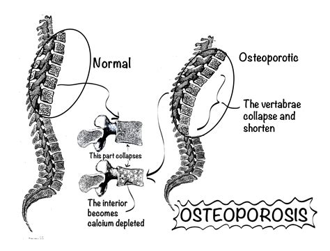 Osteoporosis Is Reversible - QUANTITATIVE MEDICINE
