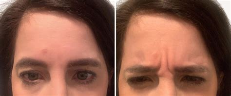 Image result for Botox Injection Pattern Forehead