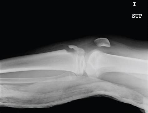 Sudden Anterior Tibial Tubercle Avulsion Fracture