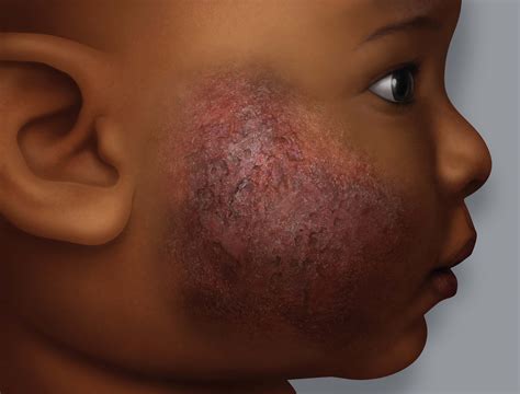 why doctor's struggle to identity eczema on darker tones Background