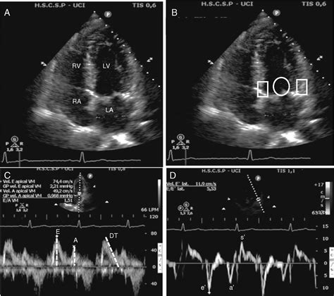 Echo Diastolic Dysfunction