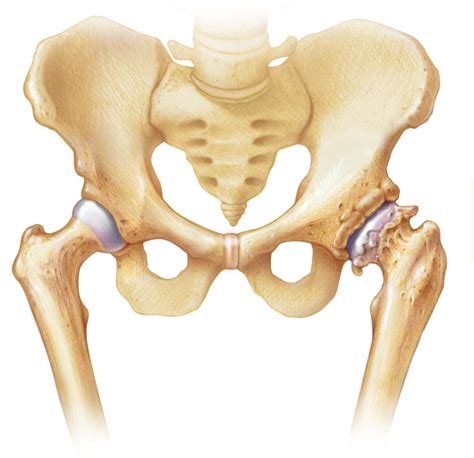 Komplikasi Osteoartritis - Ambisius Wiki