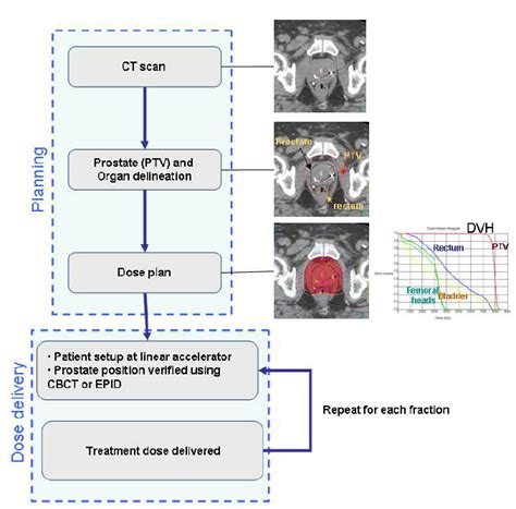 Prostate Radiation Simulation 的图像结果