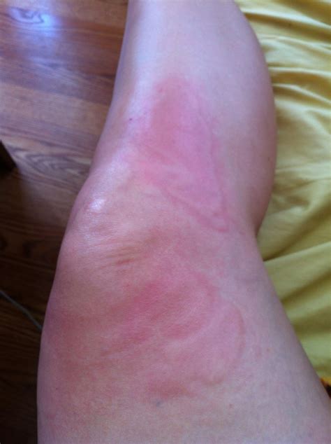 Ice Pack Burn Skin Discoloration Treatment at Douglas Wilder blog