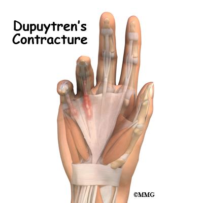 Dupuytren's Contracture - eOrthopod.com