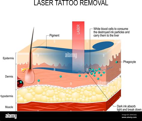 Laser tattoo removal. How Does Laser Tattoo Removal Work. Dark ink ...