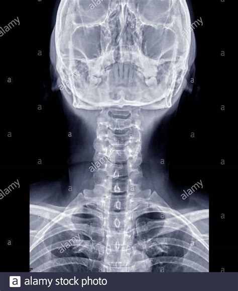 Cervical Spine Diagram X Ray