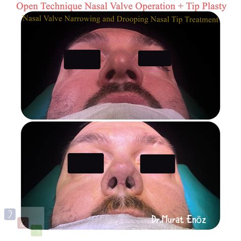 Nasal Valve Collapse and Treatment