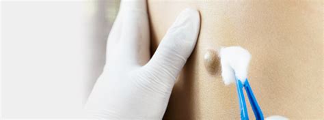 Image result for Sebaceous Cyst Removal Procedure