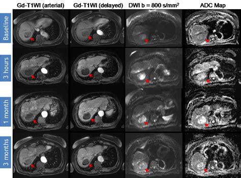 The Role of Diffusion-Weighted Imaging (DWI) in Locoregional Therapy ...