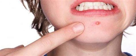 10 Tips on How To Treat Acne Naturally – Oshea Herbals