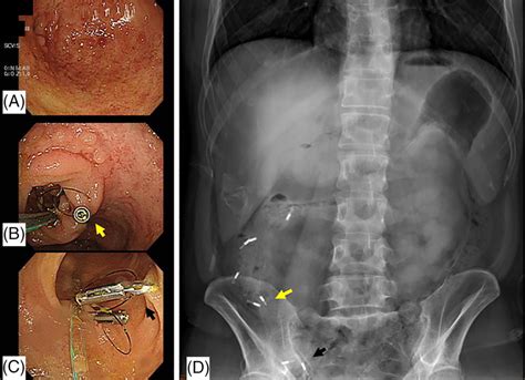 Image result for Colonoscopy Colitis