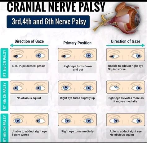 CRANIAL NERVE PALSY; *Third, fourth, and sixth cranial nerve palsies ...