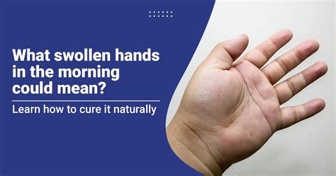 Waking Up With Swollen Hands