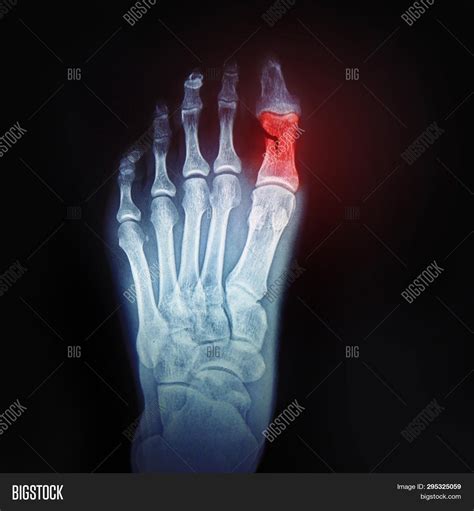 Broken Toe. X-ray Foot Image & Photo (Free Trial) | Bigstock
