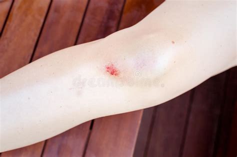 受伤的女性膝盖 库存图片. 图片 包括有 受伤的女性膝盖 - 47016927