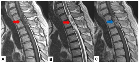 State-of-the-Art and New Treatment Approaches for Spinal Cord Tumors