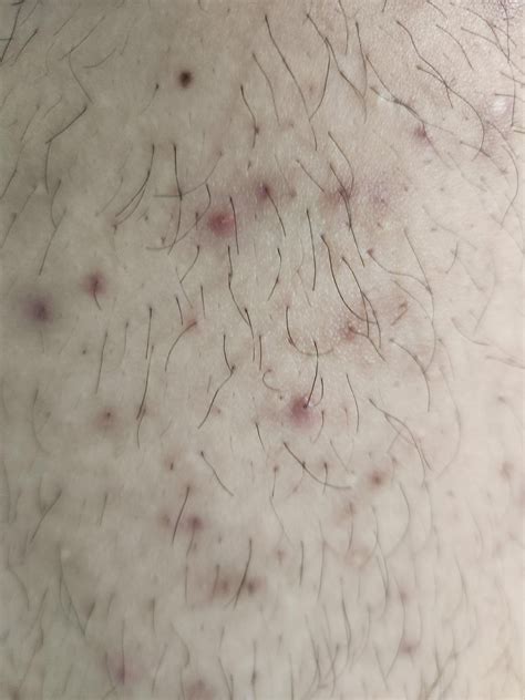 [Acne] dark and red spots on leg/buttocks : r/SkincareAddiction